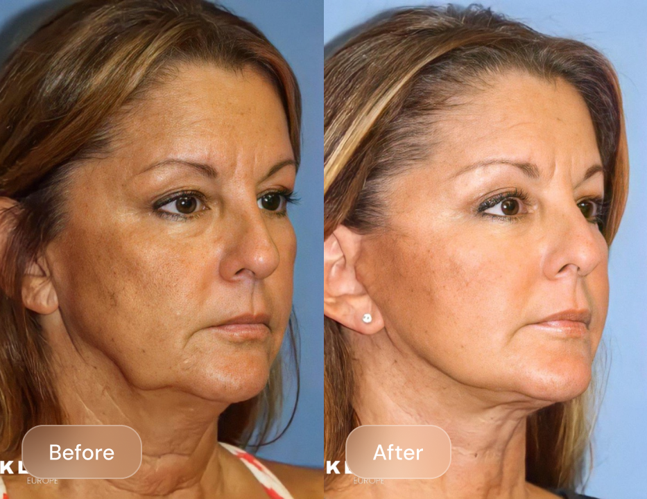 Client result
